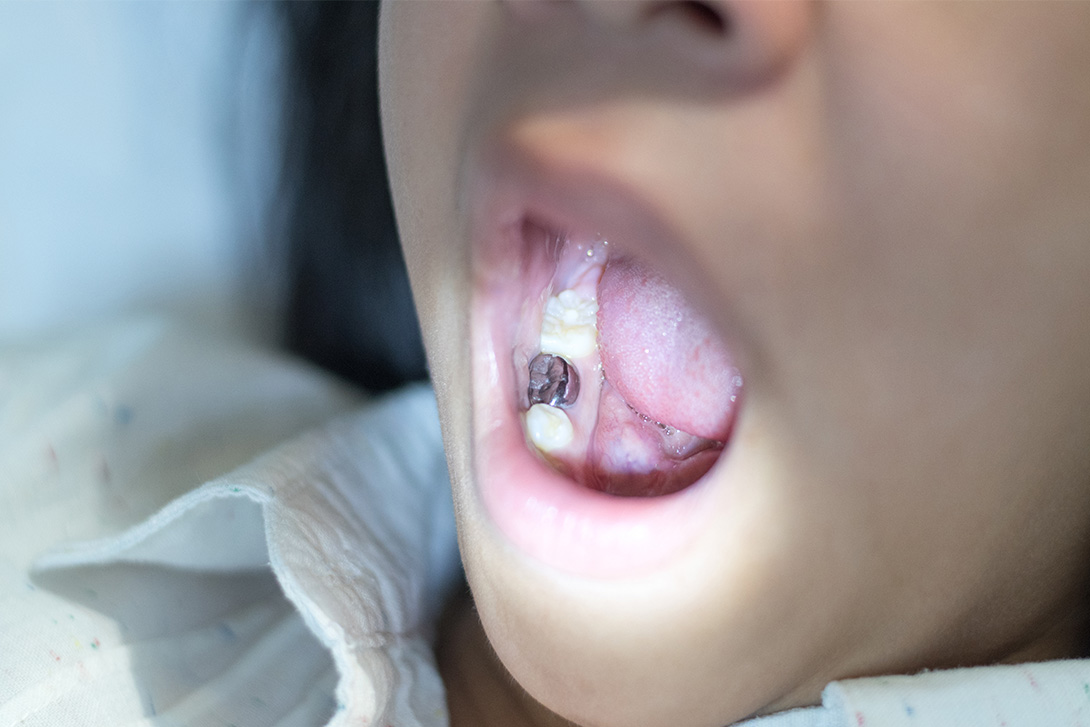 メタルフリー｜国領あおぞら歯科クリニック