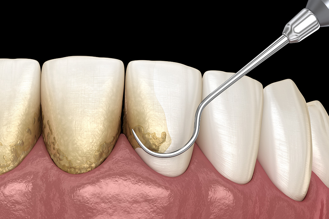 歯周病治療｜国領あおぞら歯科クリニック
