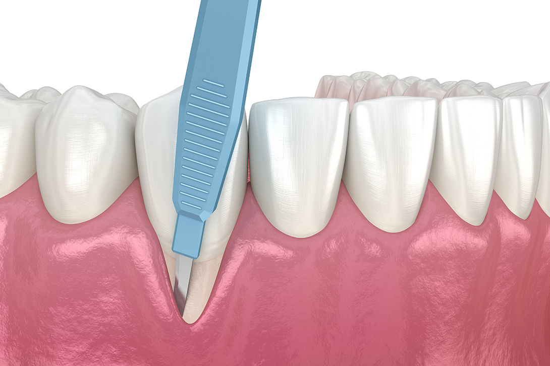 歯周病治療｜国領あおぞら歯科クリニック