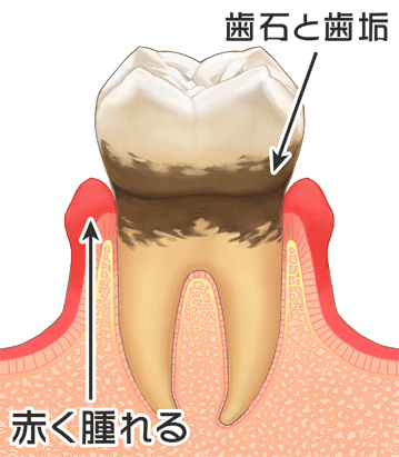 歯周病(レベル2)｜国の領あおぞら歯科クリニック