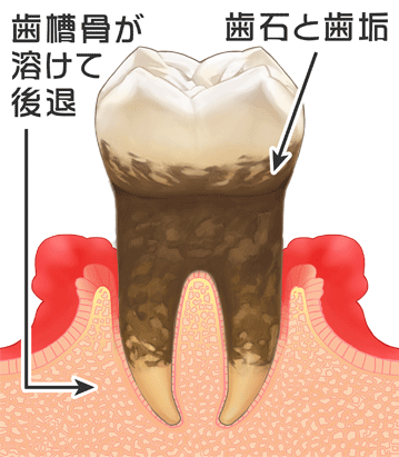 歯周病(レベル3)｜国の領あおぞら歯科クリニック