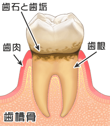 歯周病の始まり、歯肉炎｜国の領あおぞら歯科クリニック