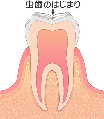 虫歯のでき始め(C0)｜国領のあおぞら歯科クリニック