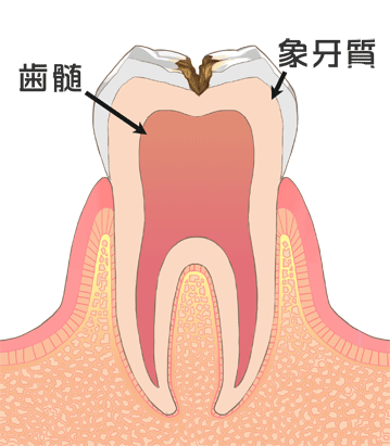 象牙質まで進行した虫歯(C2)｜国領のあおぞら歯科クリニック