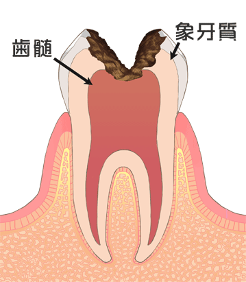 歯髄まで進行した虫歯(C3)｜国領のあおぞら歯科クリニック