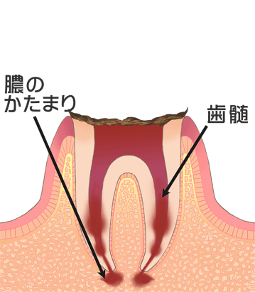 虫歯で根だけになってしまった歯(C4)｜国領のあおぞら歯科クリニック