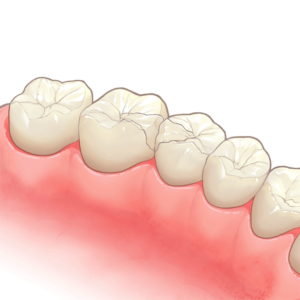 歯の治療、詰め物・被せ物｜国領のあおぞら歯科クリニック