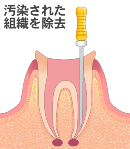 根管治療｜国領のあおぞら歯科クリニック