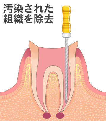 根管治療|国領のあおぞら歯科クリニック